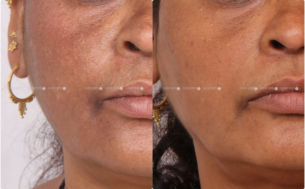 Melasma Results 3 Sessions 3 Months ClearSkin Pune