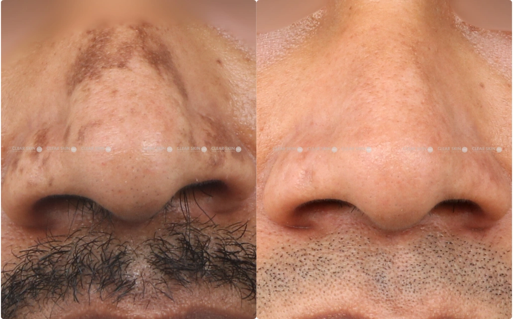 Melasma Results 9 Sessions 10 Months ClearSkin Pune