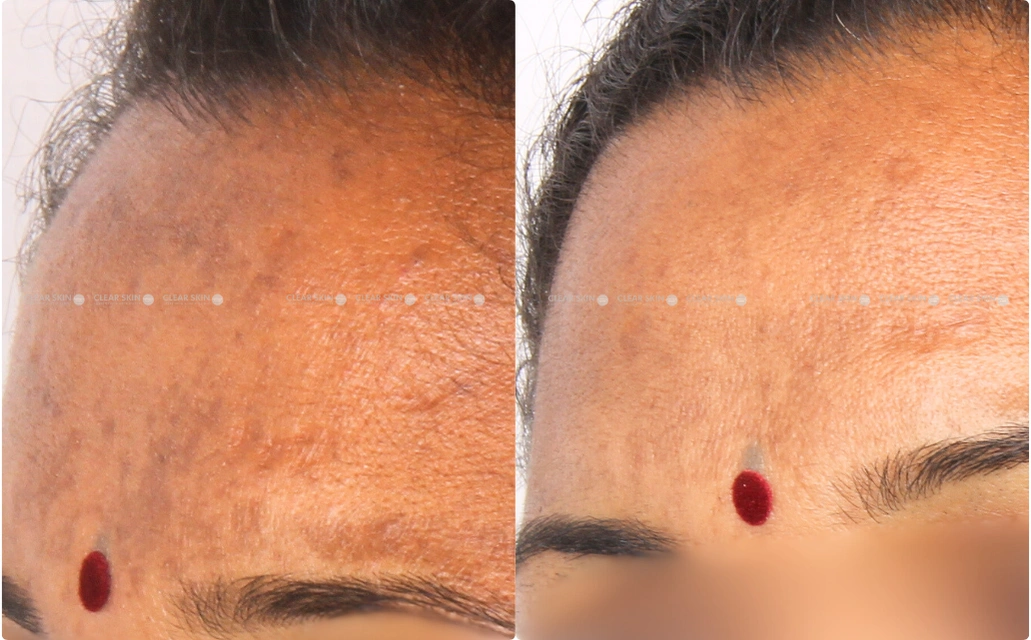 Melasma Results 9 Sessions 10 Months ClearSkin Pune