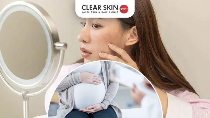 Melasma-Treatment-During-Pregnancy-Clear-Skin-Pune