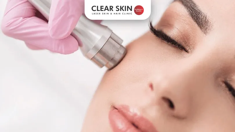 Microdermabrasion for Acne Scars