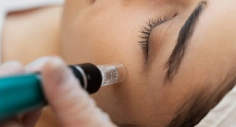 Microneedling