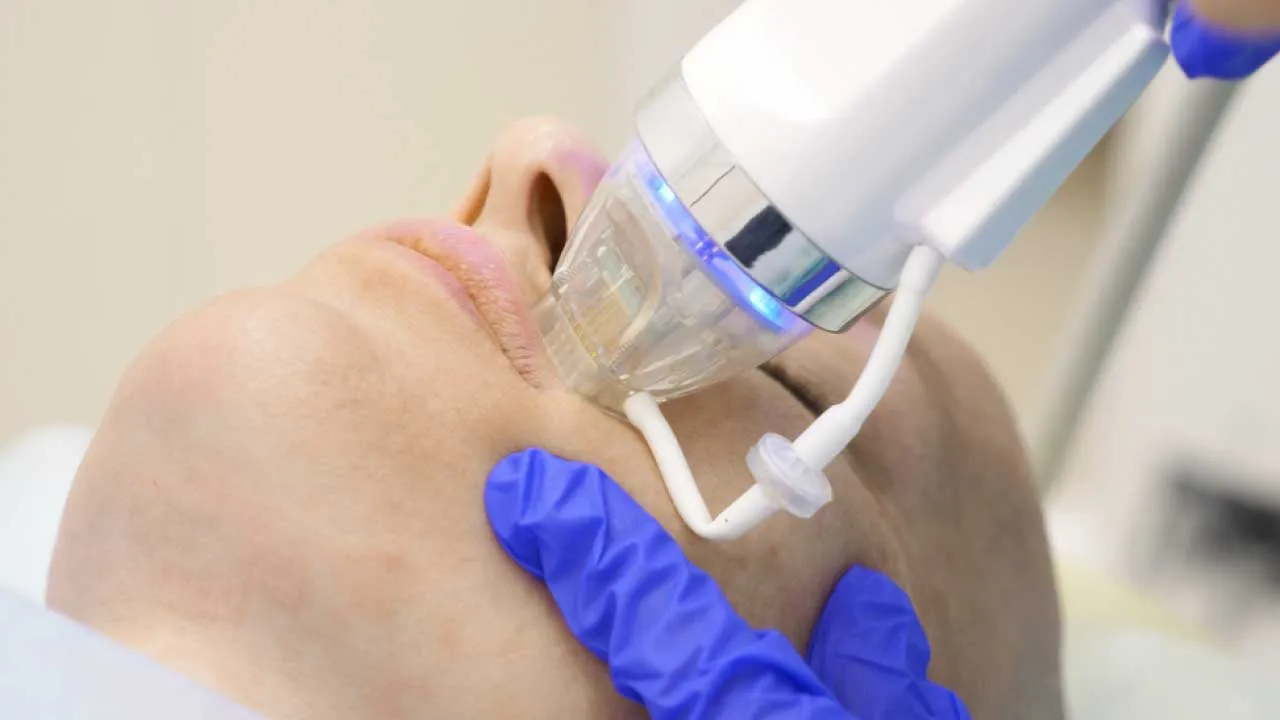 Microneedling Radiofrequency Post Care Treatment