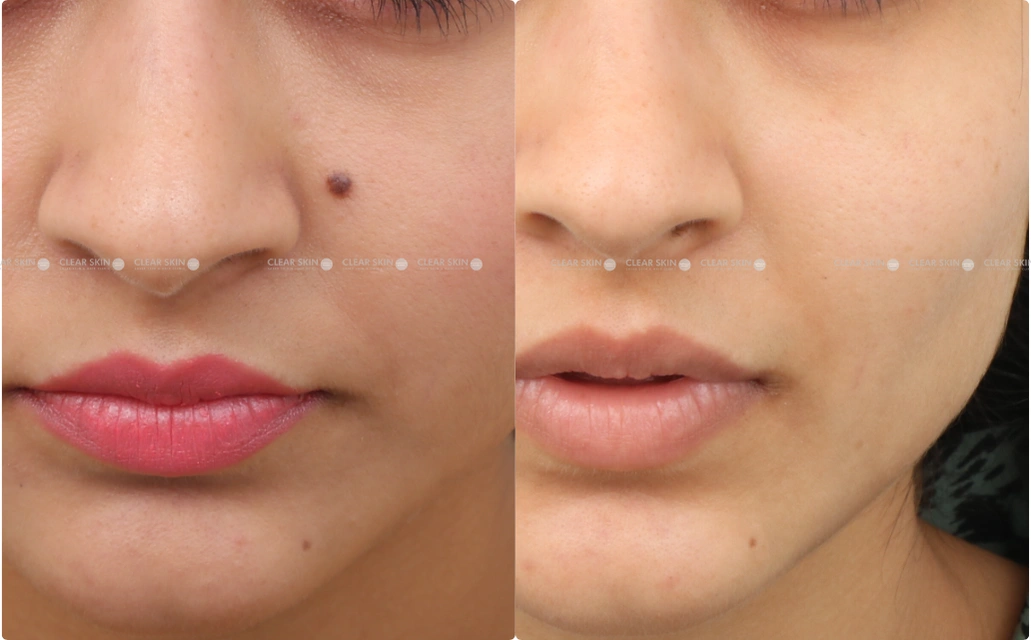 Mole Removal Results 2 Sessions 2 Months ClearSkin Pune