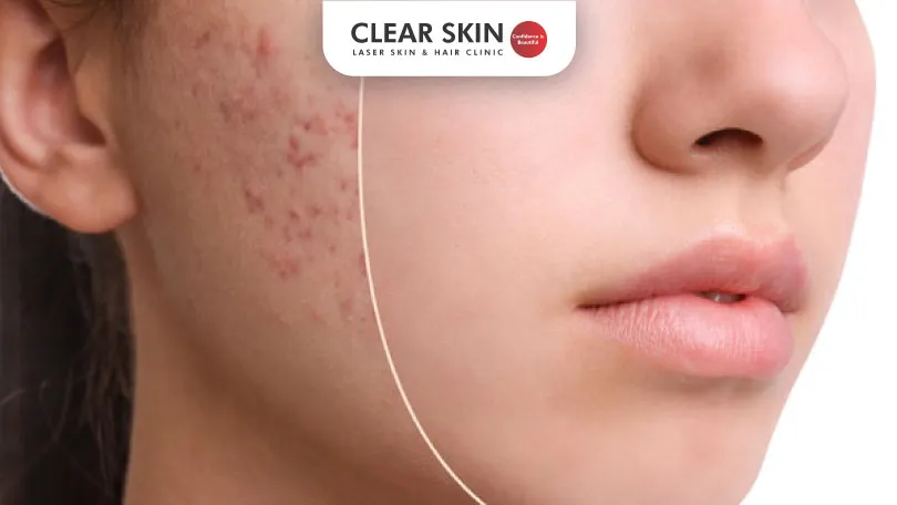 Naturally Eliminating Acne Scars: Expert Tips for Clearer Skin