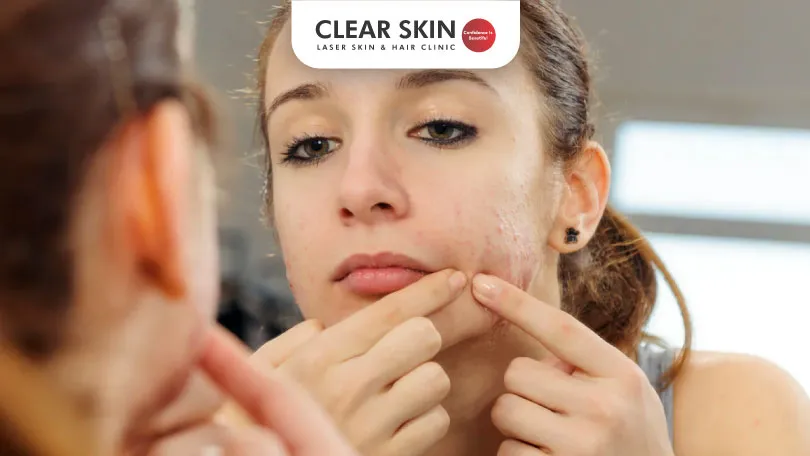 Navigating Acne Treatment: Options & Self-Care Strategies