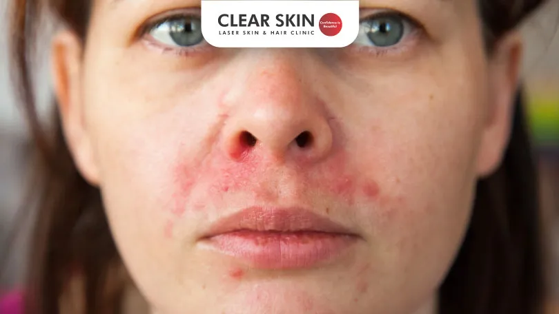 Perioral Pigmentation Home Remedies Clinical Treatment Clear Skin Pune