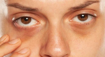 Persistent Dark Circles