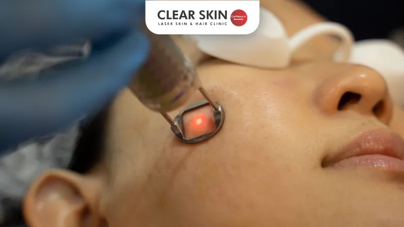 Pico Laser Treatment for Melasma