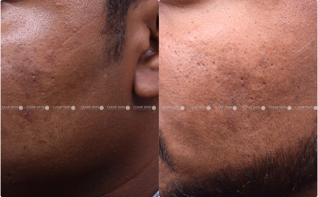 Pigmentation Results 3 Months Timeline 5 Sessions ClearSkin Pune