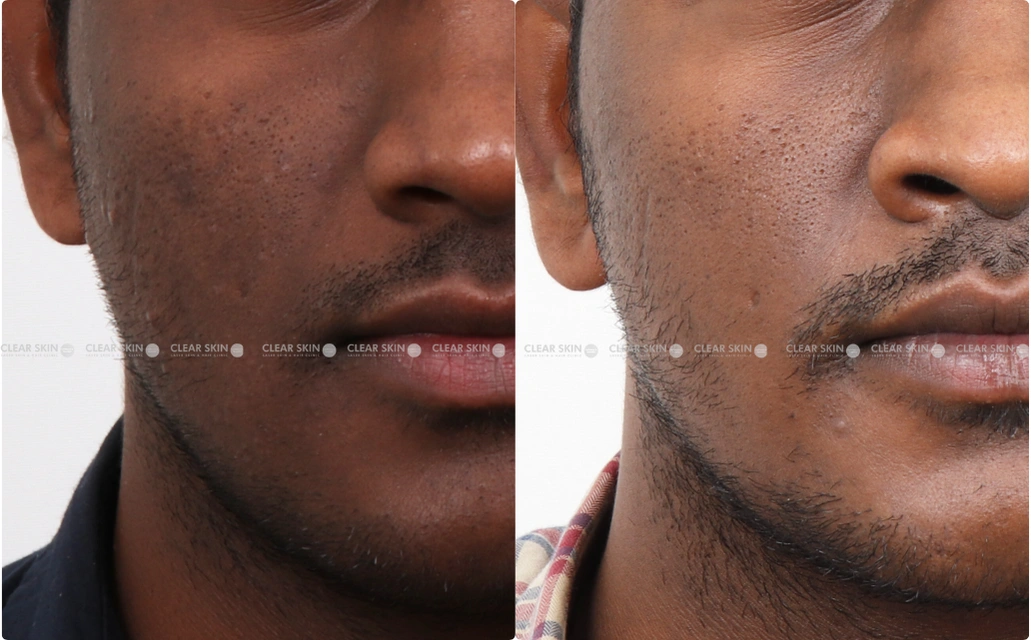 Pigmentation Results 3 Sessions 3 Months ClearSkin Pune