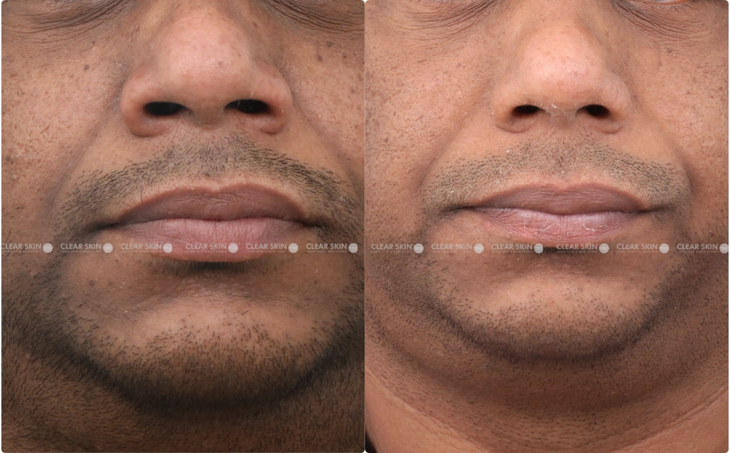 Pigmentation Results 4 Months Timeline 4 Sessions ClearSkin Pune