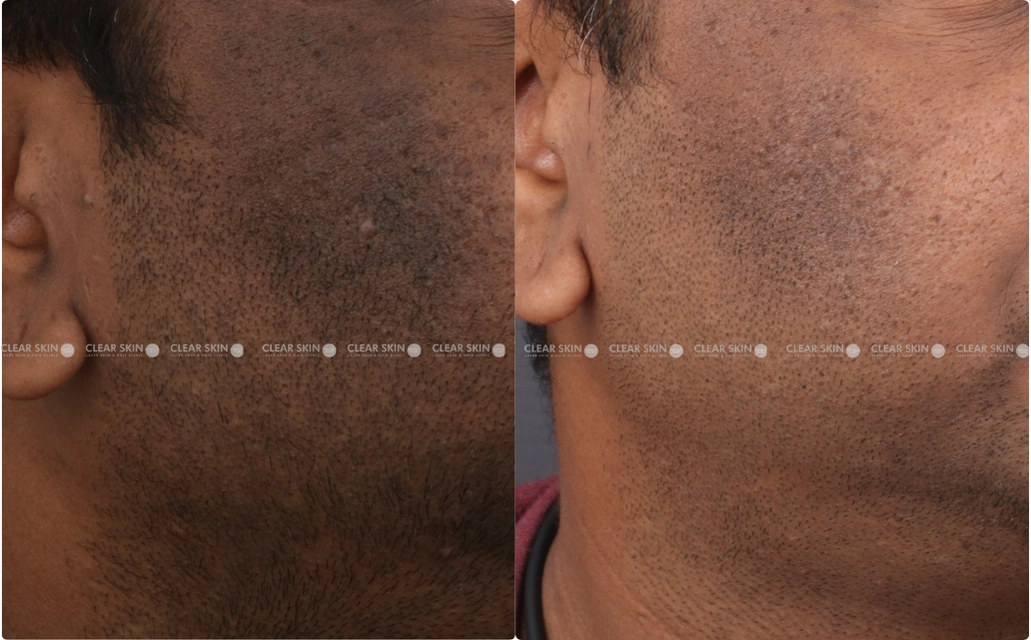 Pigmentation Results 4 Months Timeline 4 Sessions ClearSkin Pune