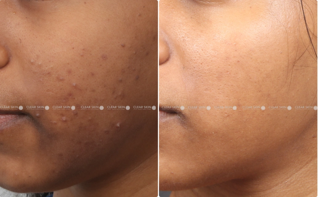 Pigmentation Results 5 Months Timeline 6 Sessions ClearSkin Pune