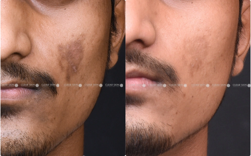 Pigmentation Results 5 Sessions 4 Months ClearSkin Pune