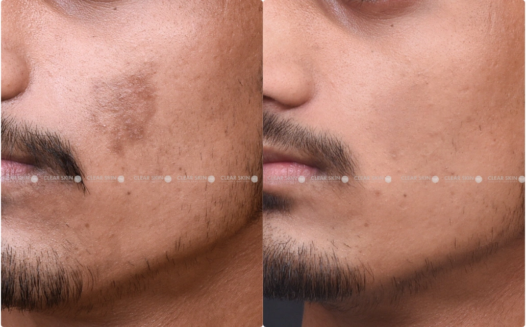 Pigmentation Results 5 Sessions 4 Months ClearSkin Pune