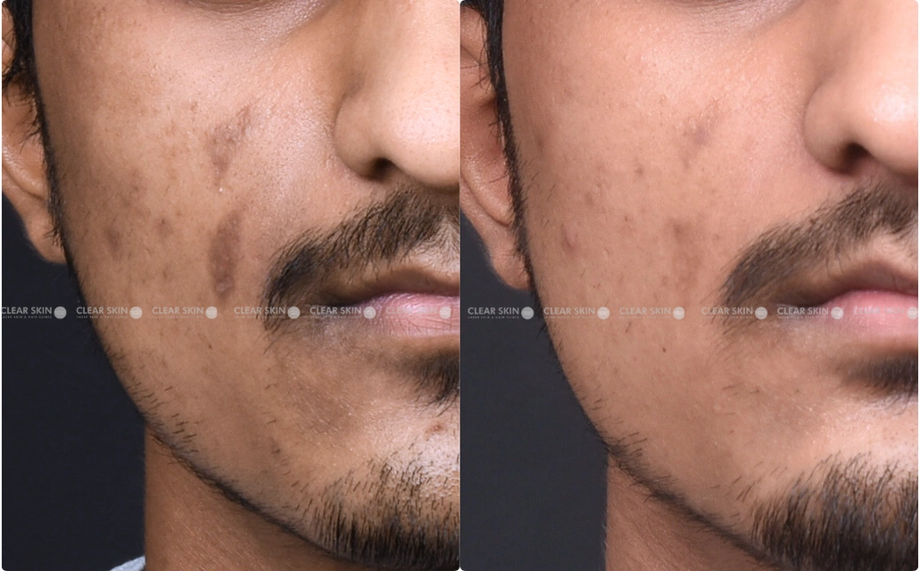 Pigmentation Results 5 Sessions 4 Months ClearSkin Pune