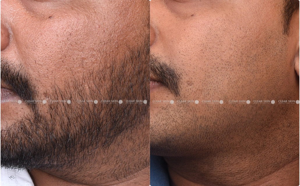 Pigmentation Results 5 Sessions 6 Months ClearSkin Pune