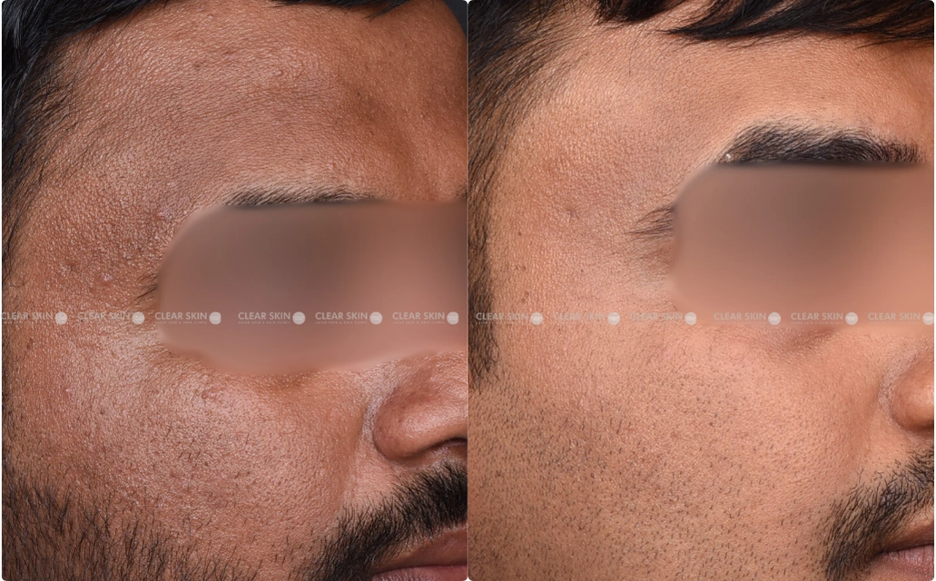 Pigmentation Results 5 Sessions 6 Months ClearSkin Pune