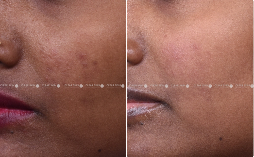 Pigmentation Results 6 Months Timeline 6 Sessions ClearSkin Pune