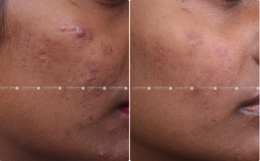 Pigmentation Results 6 Months Timeline 6 Sessions ClearSkin Pune