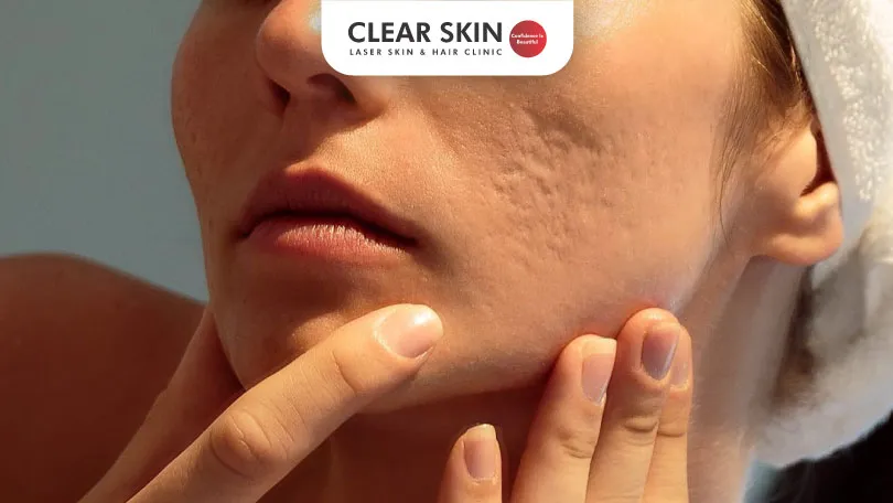 Pockmarks Treatment Get a Blemish Free Complexion Clear Skin Pune