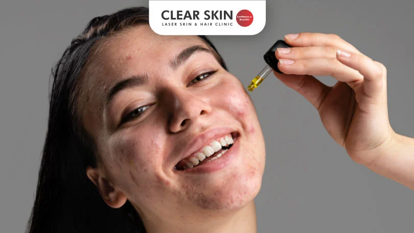 Salicylic Acid for Acne Scars: Clear Skin Pune&rsquo;s Ultimate Guide