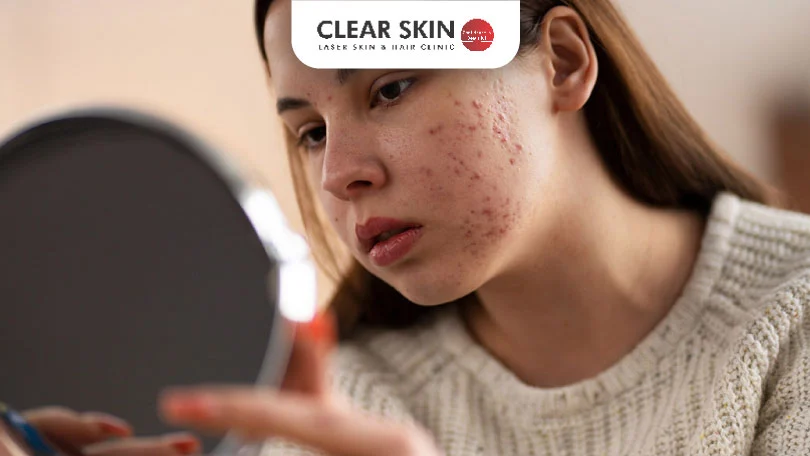 Scientific Acne Treatments and Myths | Clear Skin, Pune