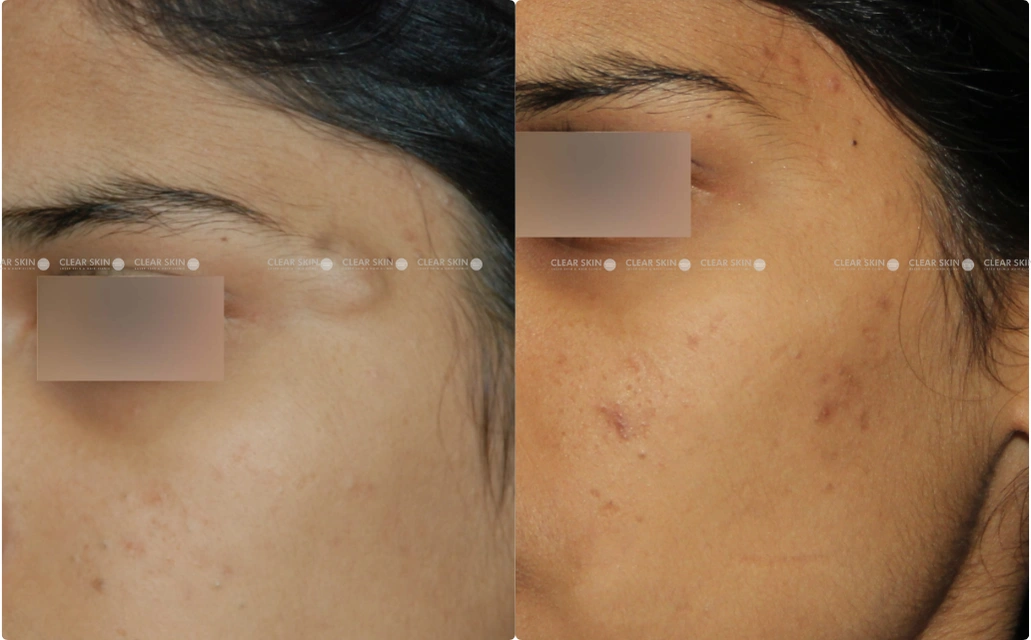 Sebaceous Cyst Removal Results 2 Sessions 3 Months ClearSkin Pune