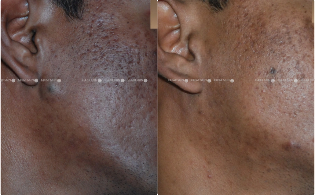 Sebaceous Cyst Removal Results 2 Sessions 4 Months ClearSkin Pune