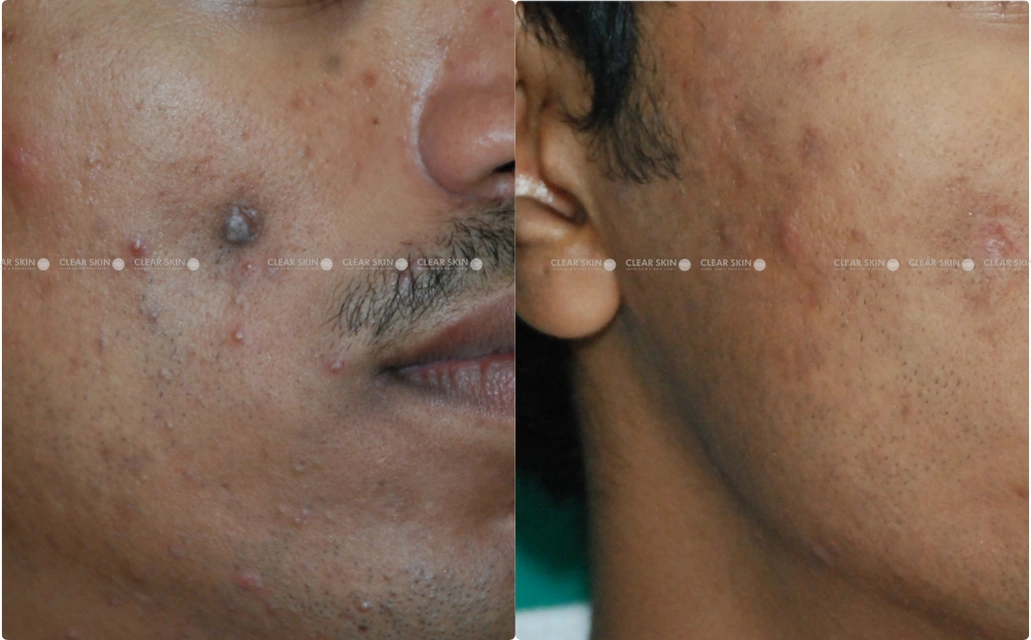 Sebaceous Cyst Removal Results 4 Sessions 3 Months ClearSkin Pune