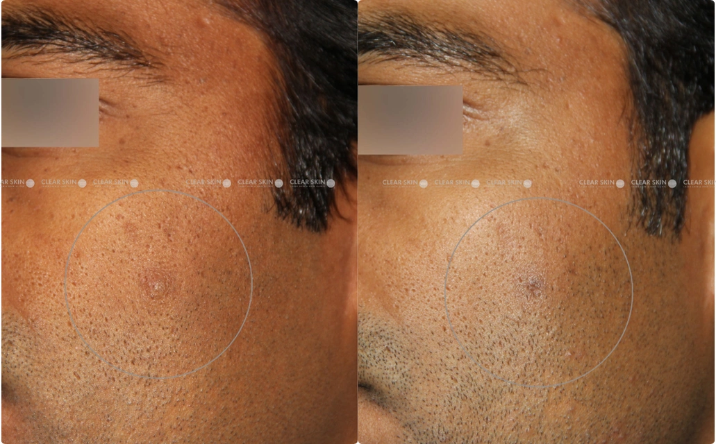 Sebaceous Cyst Removal Results 5 Sessions 4 Months ClearSkin Pune