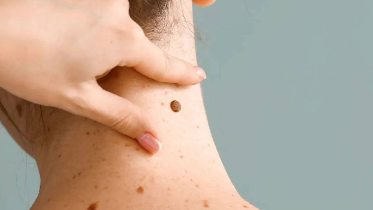 Seborrheic Keratosis