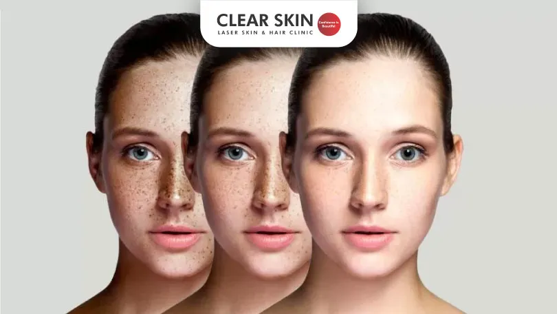 Skin Pigmentation Success Stories at Clearskin