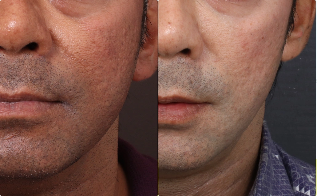 Skin Rejuvenation Results 4 Sessions 5 Months ClearSkin Pune