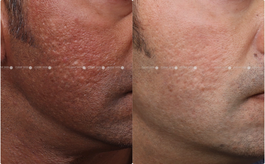 Skin Rejuvenation Results 4 Sessions 5 Months ClearSkin Pune