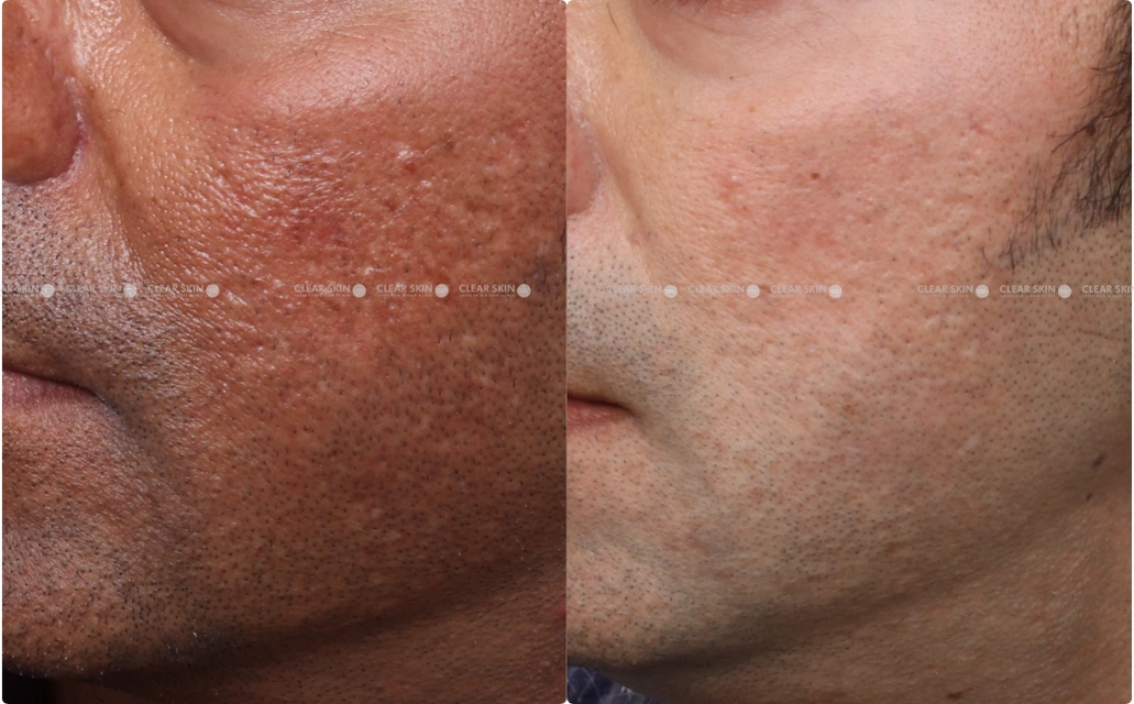 Skin Rejuvenation Results 4 Sessions 5 Months ClearSkin Pune