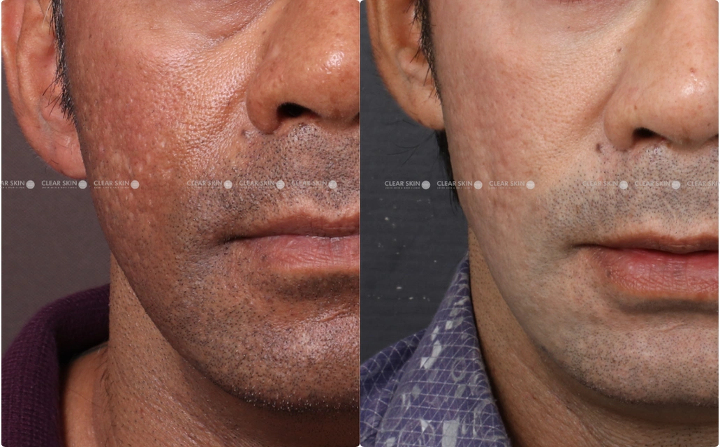 Skin Rejuvenation Results 4 Sessions 5 Months ClearSkin Pune