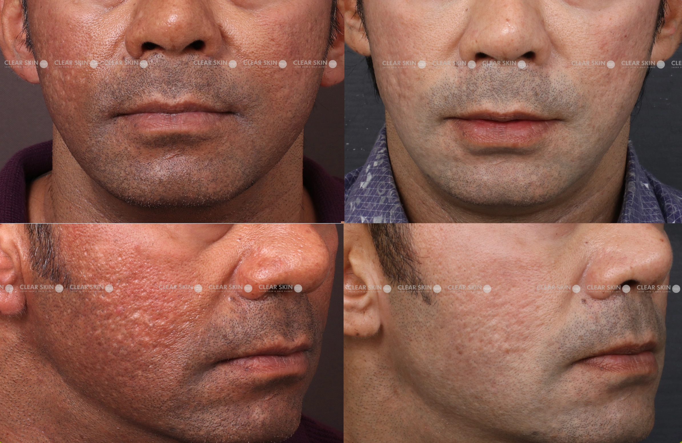 Skin Rejuvenation-Results 5 Months Timeline 5 Sessions ClearSkin Pune