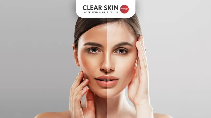 Skin-Tan-Removal-Treatment-Patient-testimonials-clear-skin-pune