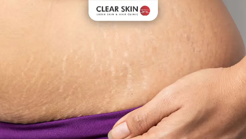 Effective Stretch Marks Treatment & Causes