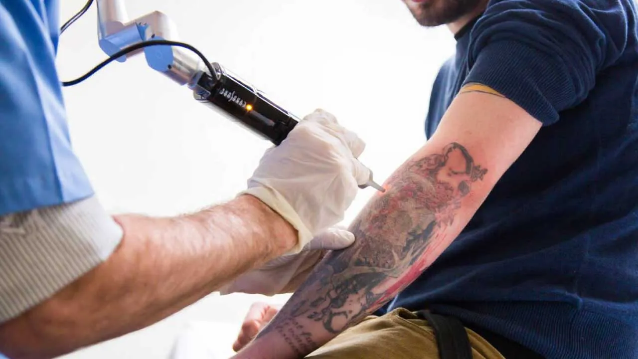 Tattoo Removal