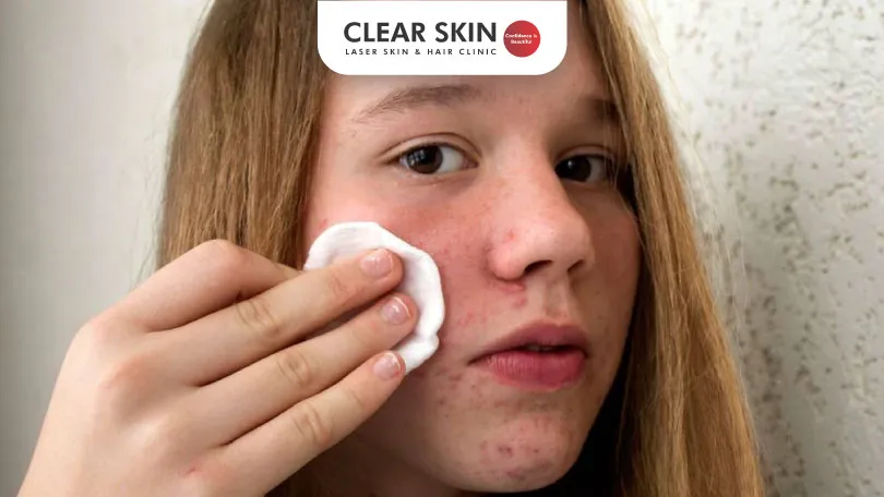 How to Get Rid of Teenage Pimples Naturally | Clear Skin Pune