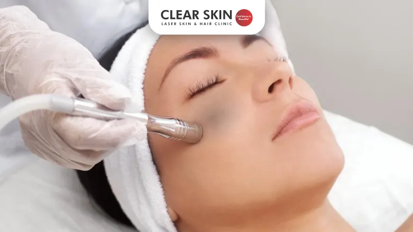 Exploring the Benefits of Microdermabrasion for Melasma