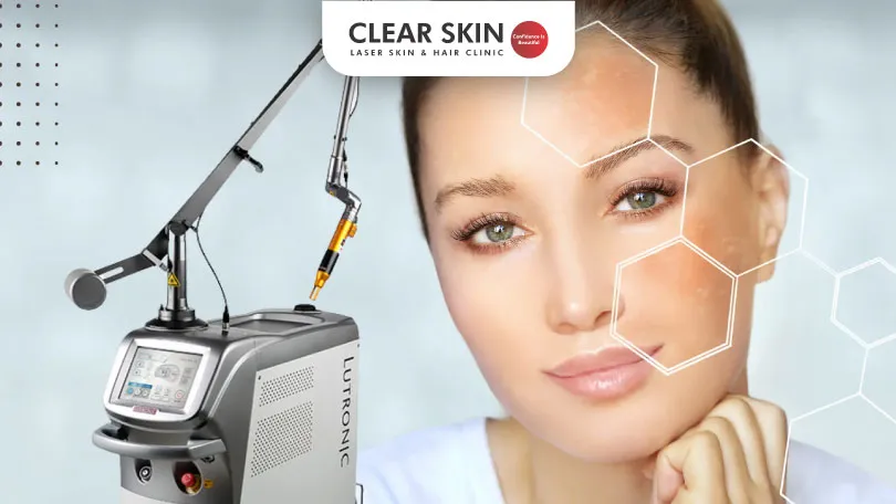 The Benefits of Q Switch Laser Treatment for Melasma Clear Skin Pune