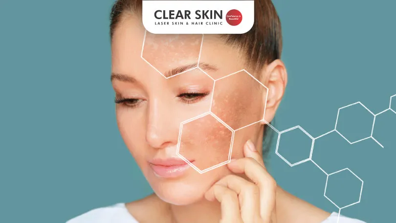 The Hormonal Connection to Melasma