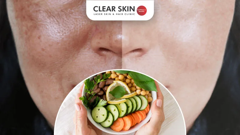 The link between diet and melasma treatment