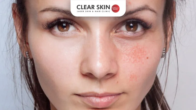 The Pros and Cons of Spot Peel Treatment for Melasma clear skin pune