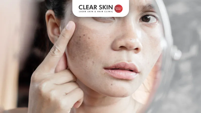 FDA-Approved Melasma Treatments for Safe Skin Discoloration Care