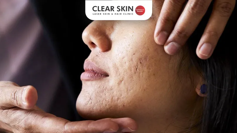 Types of Acne Scars: Treatments For Each Kind Of Scarring